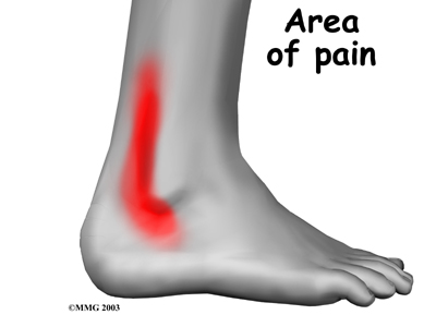 ankle_peroneal_tendinitis_symptoms01