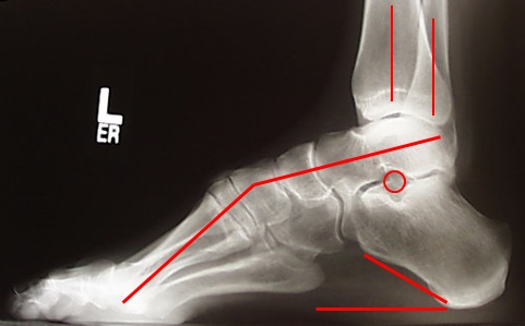 CMT-Lateral-X-ray-Figure-2A_thumb