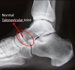 Figure-1-Talonavicular-Arthritis_thumb