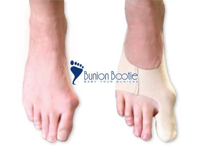 1426198925_Bunion-Bootie-Before-After